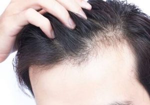 جلوگیری از ریزش مو با این روش‌ها قطعی است