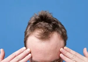 کدام ریزش مو در مردان شایعتر است؟