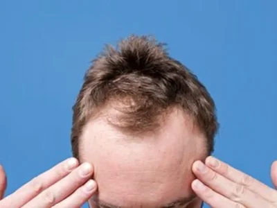 کدام ریزش مو در مردان شایعتر است؟